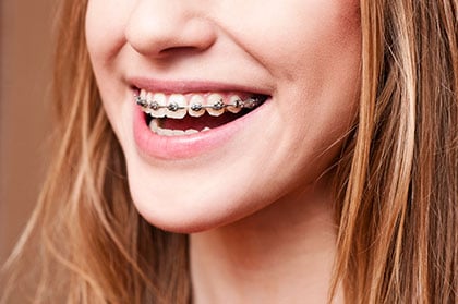 Traditional Braces