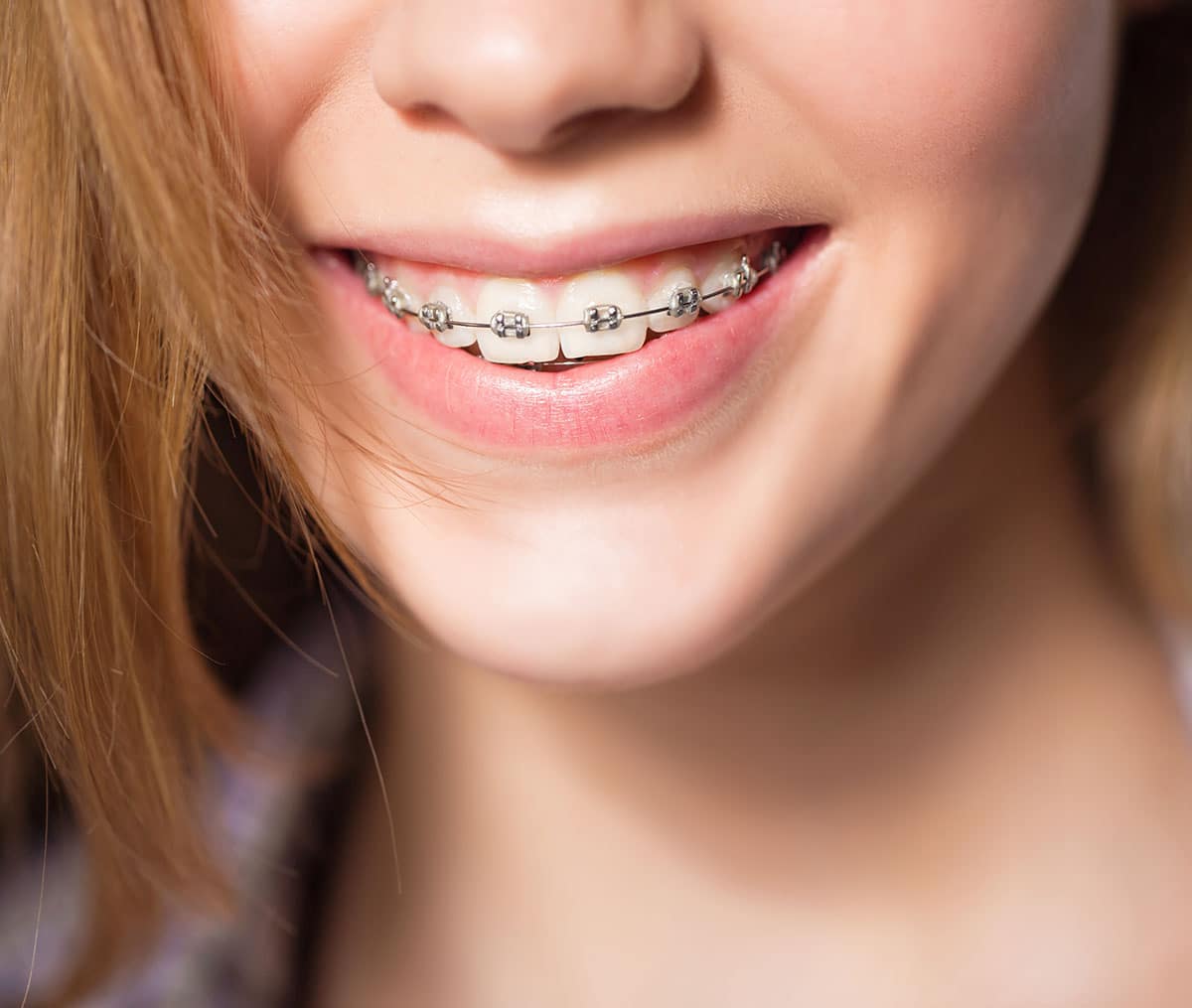 Traditional Braces