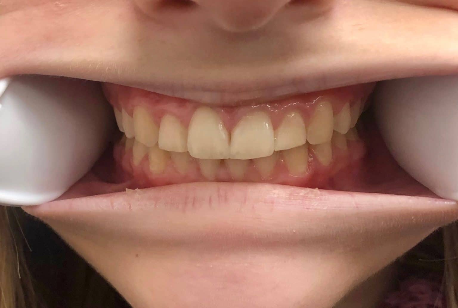 Virtual Smile Assessment Rose Orthodontics