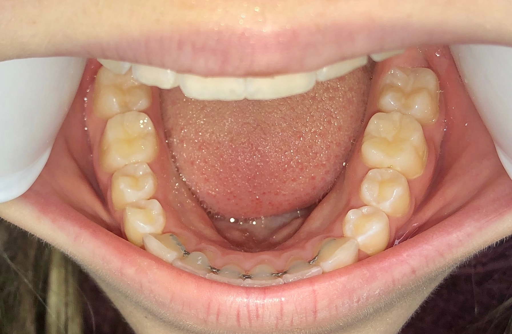 Virtual Smile Assessment Rose Orthodontics